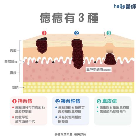 下巴痣長毛|痣變大、痣多或長毛會變皮膚癌？認識痣的形成與原因